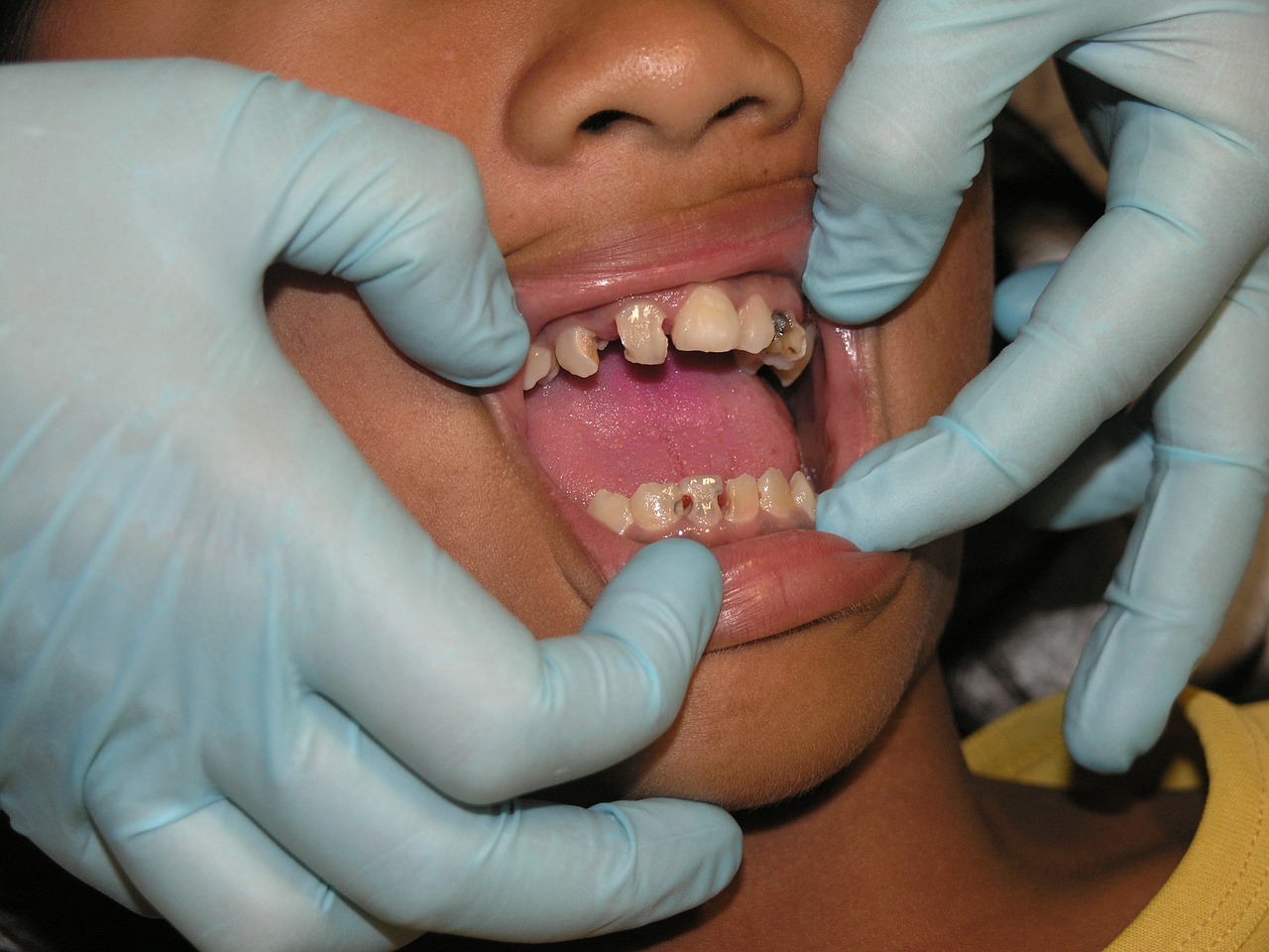 tooth decay